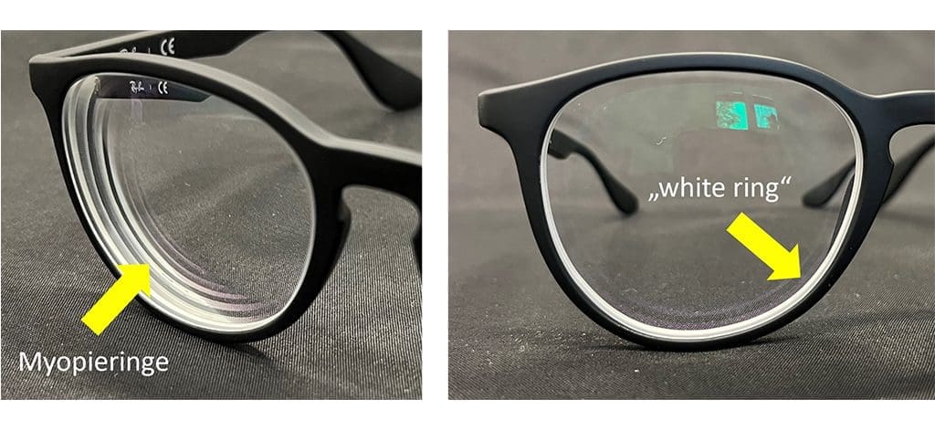 Abb. 2: Myopieringe und „white rings“ beeinflussen den Gesamteindruck der Brille. (Beispielbrille mit -4 dpt Gläsern)