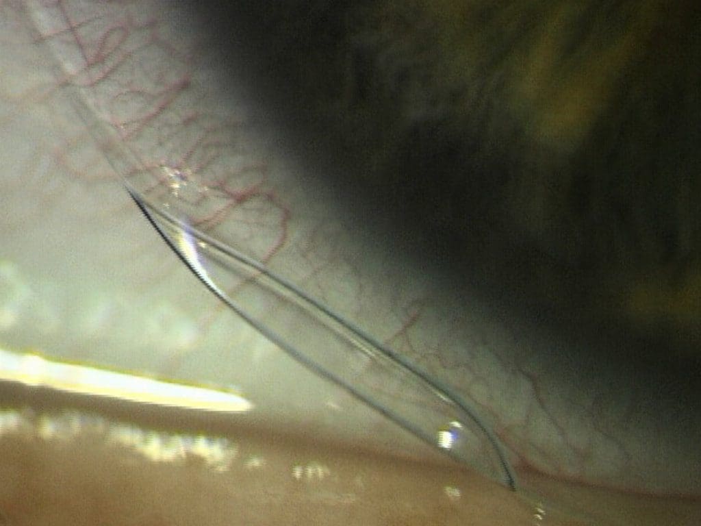 Randabhebung einer weichen Kontaktlinse am Auge, welche aufgrund von fehlerhafter Lagerung in Leitungswasser ihre Form massiv verändert hat und nicht mehr tragbar