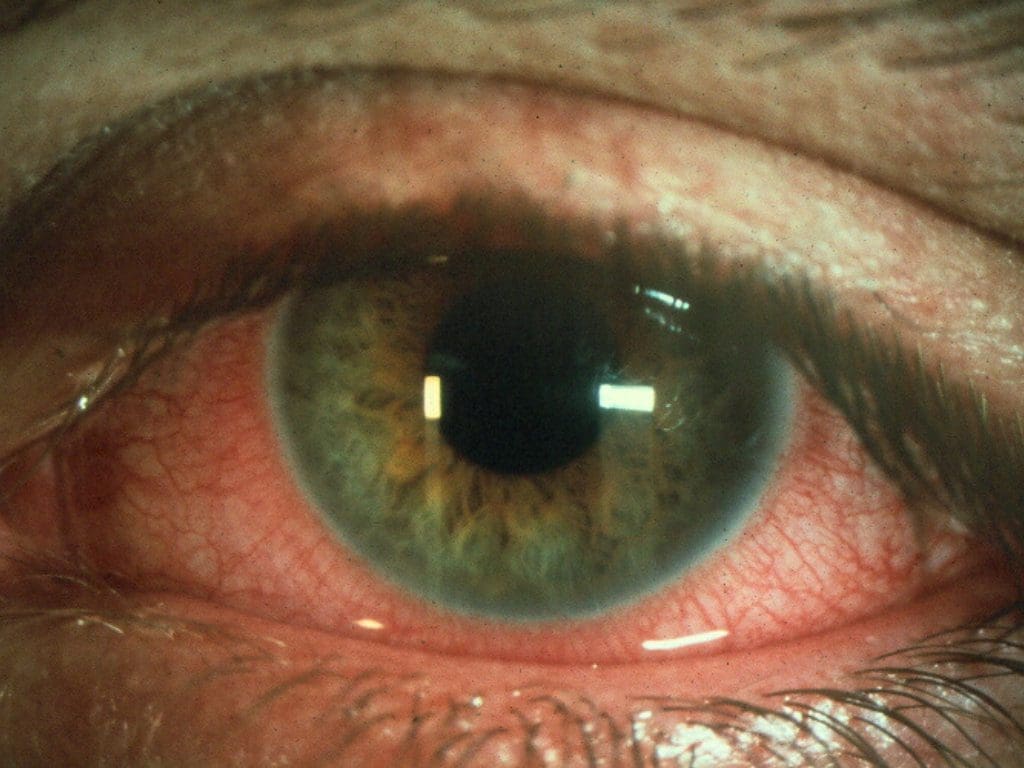 Mikrobielle Augenentzündung durch fehlerhafte Lagerung von Kontaktlinsen in Leitungswasser