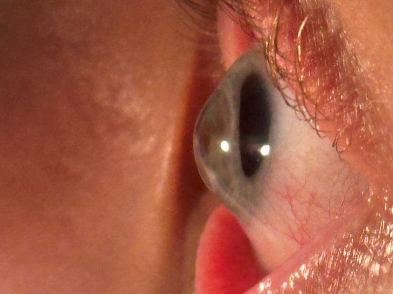 Das Potenzial von Sklerallinsen